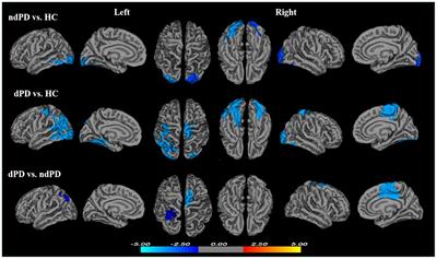 Cortical gyrification pattern of depression in Parkinson’s disease: a neuroimaging marker for disease severity?